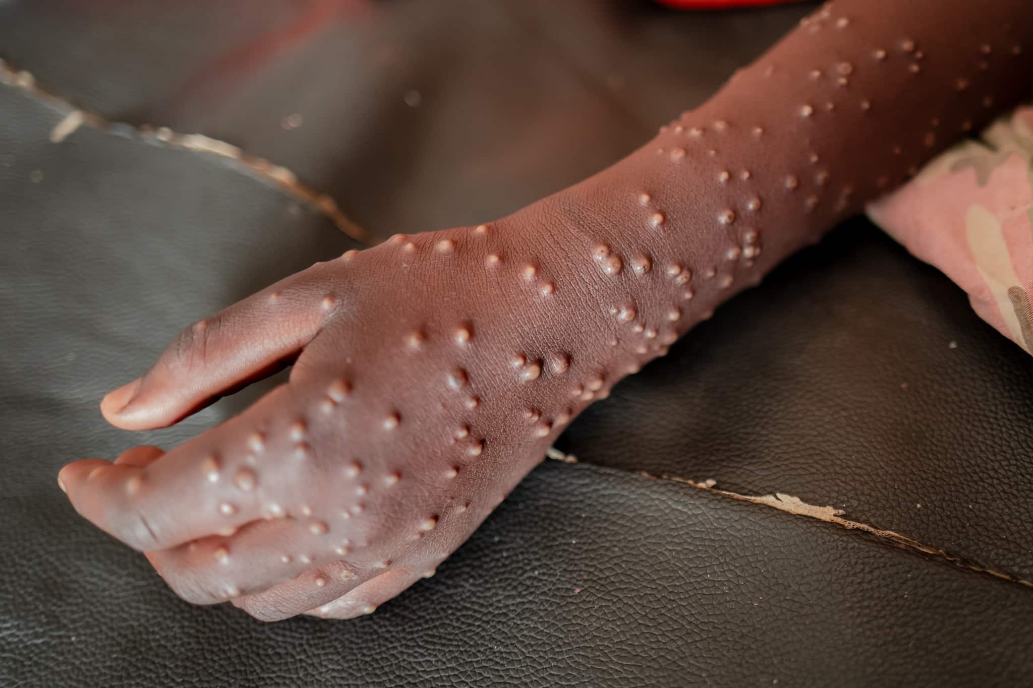 أعلنت وزارة الصحة في جنوب السودان، الجمعة، عن تفشي جدري القردة في جوبا، عاصمة البلاد وولاية الاستوائية . وجاء هذا الإعلان بعد تأكيد حالة إصابة بجدري القردة من قبل المختبر الوطني للصحة العامة في 6 فبراير 2025.